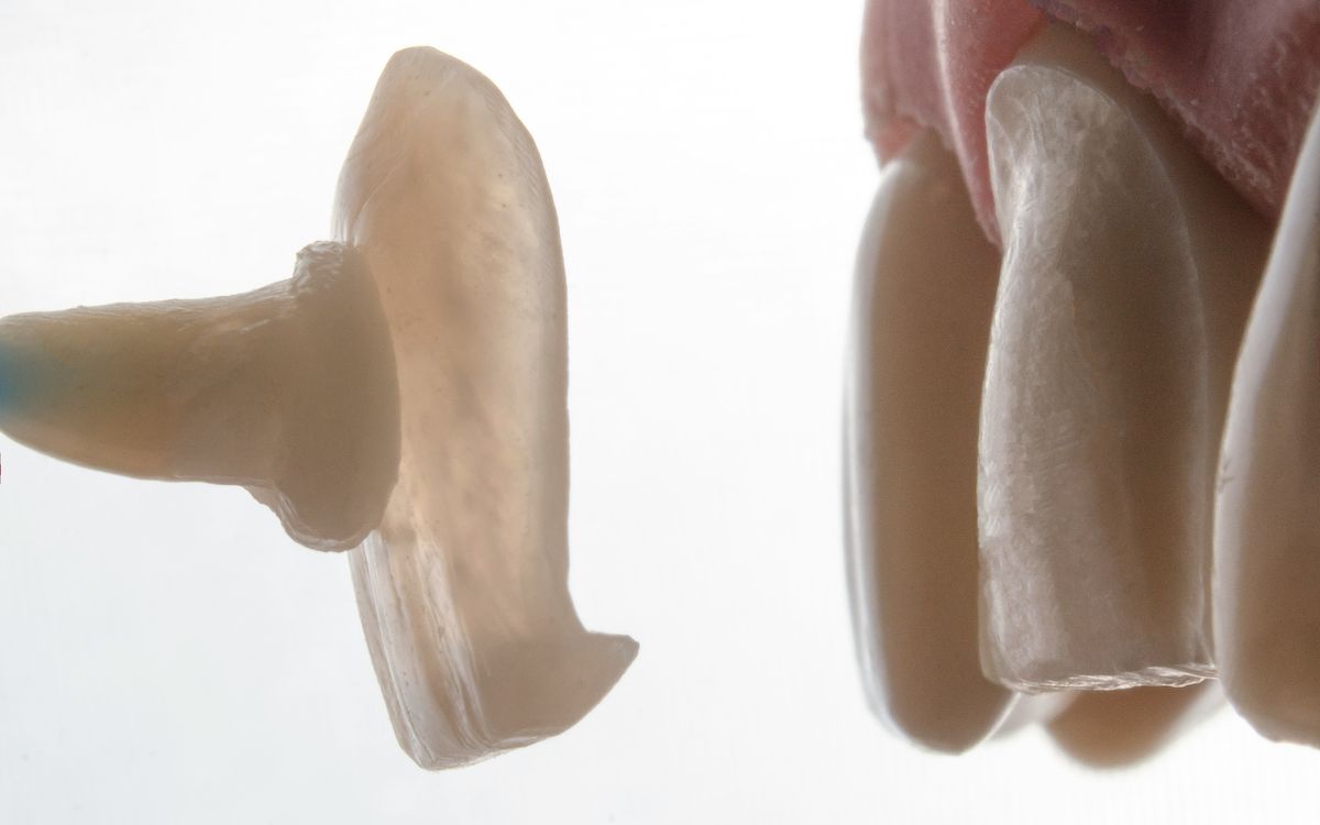 Carilla dental junto a los dientes naturales
